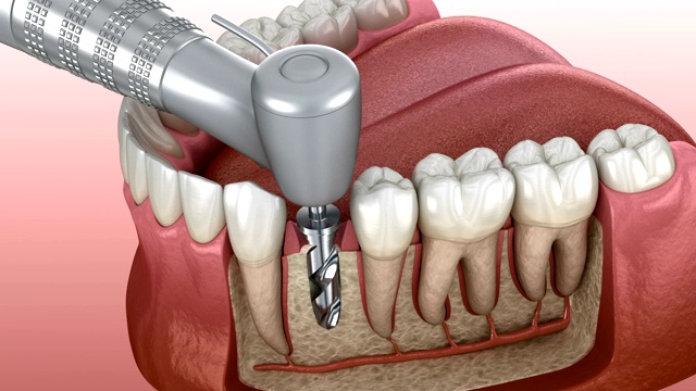 植入过程详细:钻孔、种植体安装、基台、冠固定的三维动画视频素材