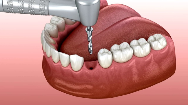 植入过程详细:钻孔、种植体安装、基台、冠固定的三维动画视频素材