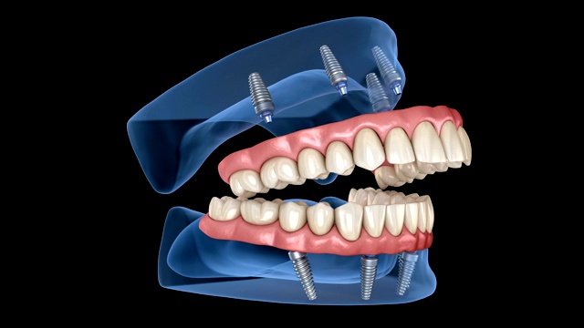 上颌、下颌骨全修复体，4个系统，种植体支持。医学上精确的人类牙齿和假牙3D动画视频素材
