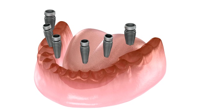 下颌骨假体全部在4个系统上，由种植体、螺钉固定。医学上精确的3D动画牙科概念视频素材