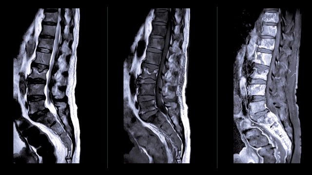 MRI L-S脊柱或腰椎矢状面视频素材