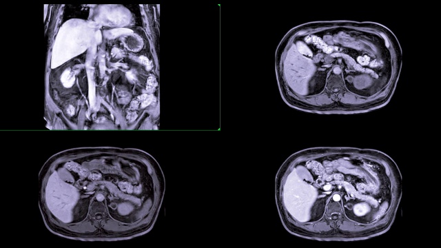 MRI上腹部冠状位、轴位T1、轴位T2和轴位T1注射钆造影剂后诊断肿瘤。视频素材