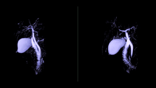 磁共振胰胆管造影或MRCP 3D MIP图像显示胆道和胰腺导管。视频素材