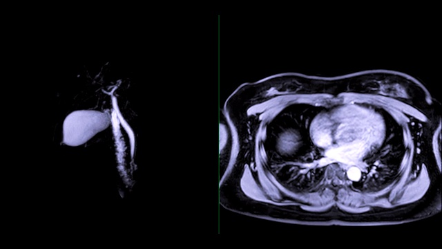 磁共振胰胆管造影或MRCP 3D MIP图像比较轴向T1W后GD胆管和胰管。视频素材