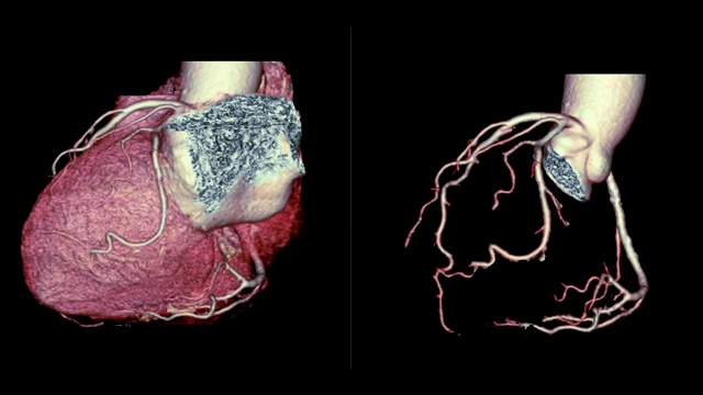 CTA冠状动脉三维渲染图像对比心脏三维和冠状动脉三维在屏幕上旋转，用于血管冠状动脉狭窄的诊断。视频素材