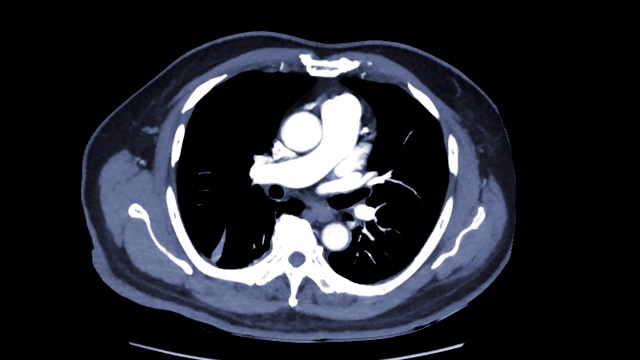 CTA胸部或CTPA检查肺栓塞(PE)显示肺动脉右侧PE。视频素材