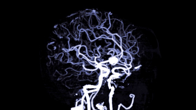 脑部CTA或脑部ct血管造影，显示前交通动脉或ACOM动脉瘤的3D渲染图像。视频素材
