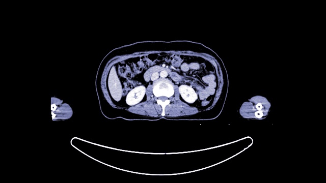 注射造影剂的全身轴位CT扫描。视频素材
