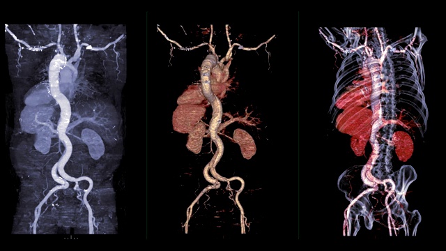 比较CTA全主动脉Mip三维渲染图像和3D及骨图像在屏幕上显示主动脉夹层。视频素材