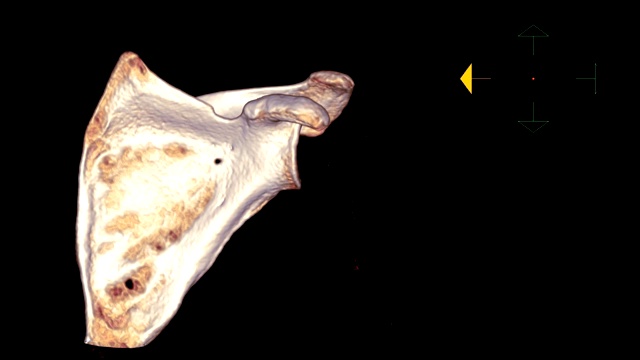 CT肩胛骨3D渲染图像在屏幕上旋转显示肩胛骨解剖。视频素材