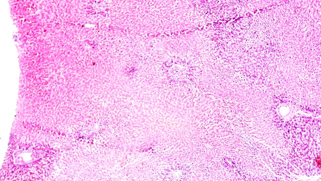 不同部位光镜下肝活检慢性充血视频素材