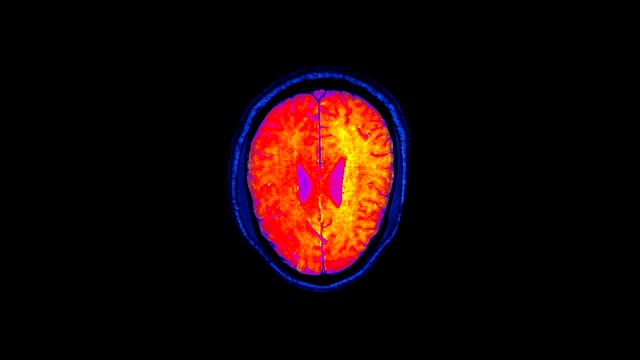 磁共振成像是MRI扫描人类大脑功能障碍、出现问题的区域。时间流逝。x射线，计算机医学体层摄影。RGB红外摄像机视频素材