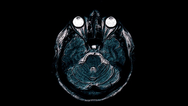 大量彩色MRI扫描大脑和头部来检测肿瘤。医疗诊断工具视频素材