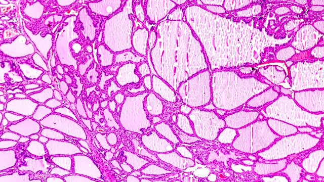 光镜下中毒性甲状腺肿(甲状腺亢进)视频素材