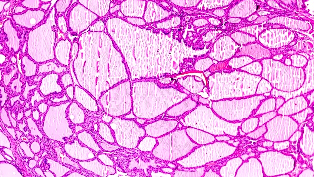 光镜下中毒性甲状腺肿(甲状腺亢进)视频素材