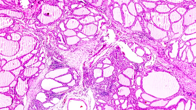 光镜下中毒性甲状腺肿(甲状腺亢进)视频素材