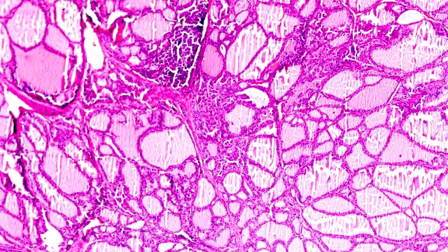 光镜下中毒性甲状腺肿(甲状腺亢进)视频素材