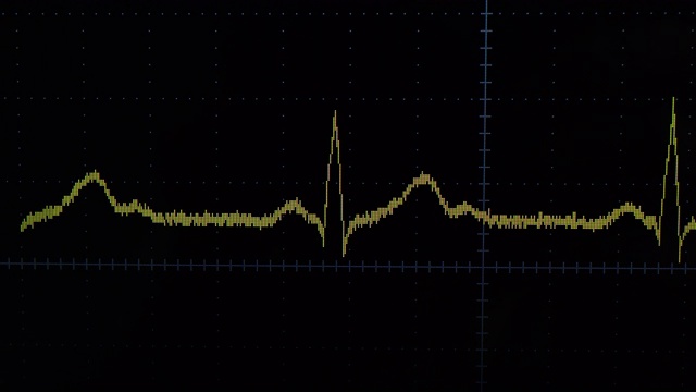 心电图波视频素材
