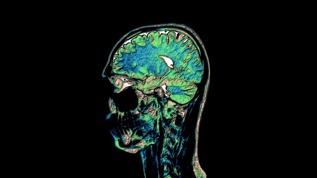 大量彩色MRI扫描大脑和头部来检测肿瘤。医疗诊断工具视频素材