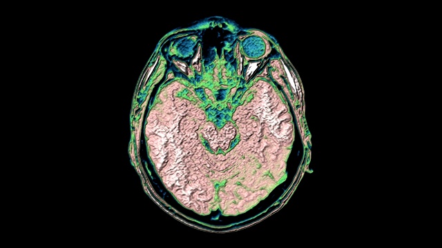 大量彩色MRI扫描大脑和头部来检测肿瘤。医疗诊断工具视频素材