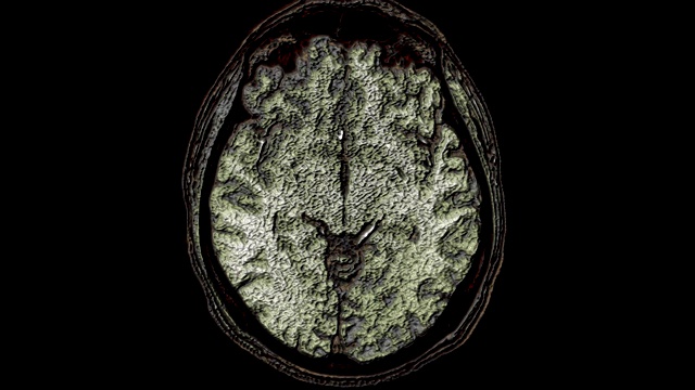 大量彩色MRI扫描大脑和头部来检测肿瘤。医疗诊断工具视频素材