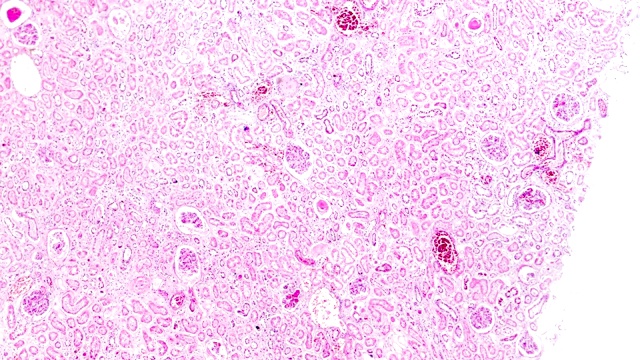 急性肾炎活检标本在显微镜下不同区域放大视频素材
