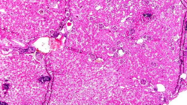 急性肾盂肾炎标本不同区域显微镜放大视频素材