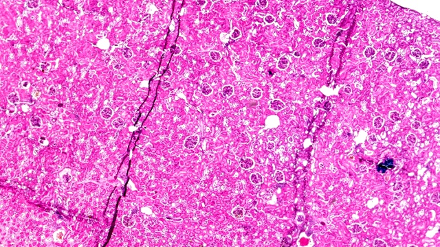 急性肾盂肾炎标本不同区域显微镜放大视频素材