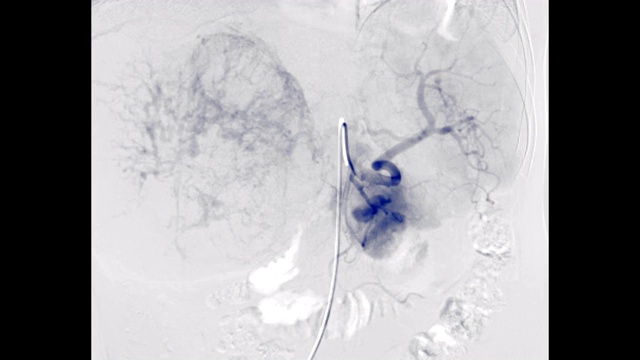 TACE或经导管动脉化疗栓塞肝细胞癌。视频素材