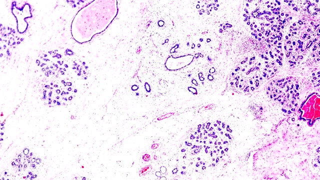 乳癌在光镜下的不同区域变焦视频素材