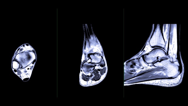 mri踝关节轴向、冠状、矢状T2比较。视频素材