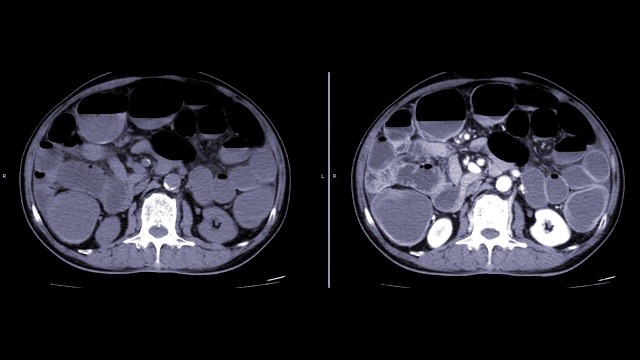 全腹非造影剂与造影剂显示肠梗阻的CT比较。视频素材