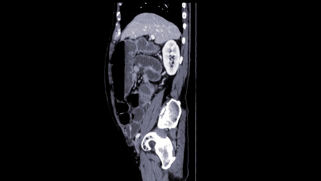 全腹CT伴造影剂矢状面显示肠梗阻。视频素材