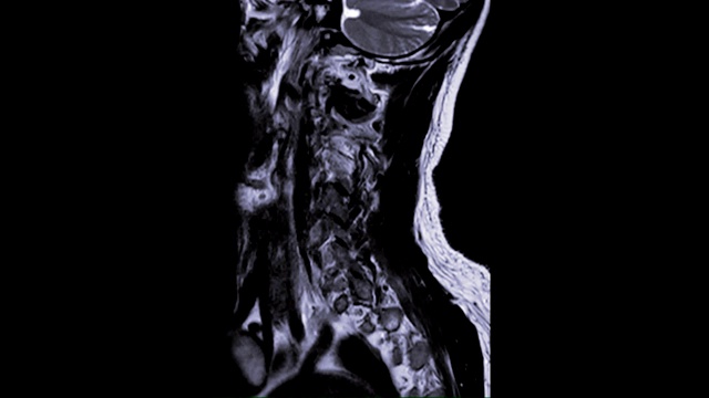 颈椎T2W矢状位MRI诊断C3、C4处脊髓受压。视频素材
