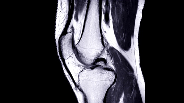 MRI膝关节或磁共振成像膝关节矢状面PDW视图。视频素材