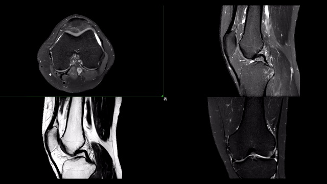 轴、矢状、冠状位膝关节搅拌技术与t2凹陷膝关节MRI或磁共振成像比较。视频素材