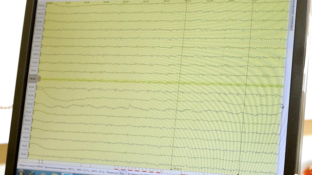 监测人类大脑活动结果的监视器的特写镜头。高清视频素材