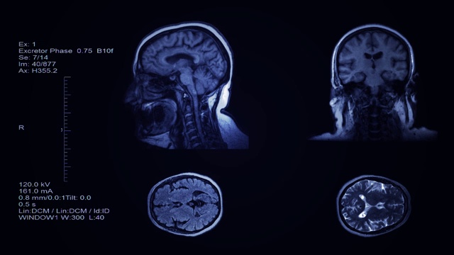 头部和脑部计算机断层扫描结果可视化。四分区幻灯片人的头部筛选。三维放射医学检查视频下载