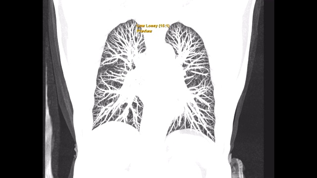 CT胸部或CT人胸部肺过滤技术冠状MIP视图诊断结核病、结核病和covid-19。视频素材