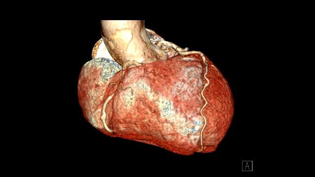 CTA冠脉三维渲染图像在屏幕上旋转，用于冠脉狭窄的血管诊断。视频素材