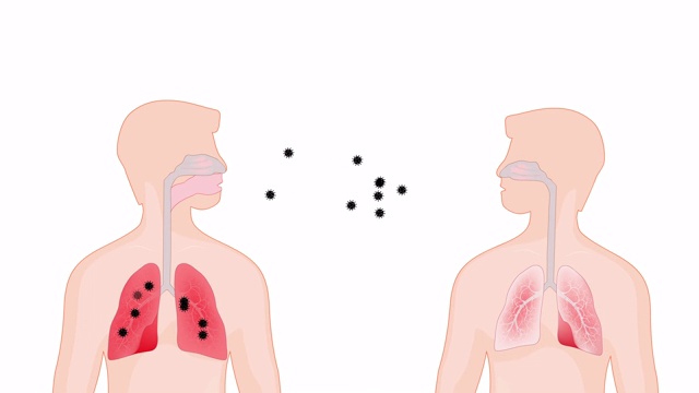 病毒。人与人之间传播。病毒的污染。冠状病毒在肺视频下载