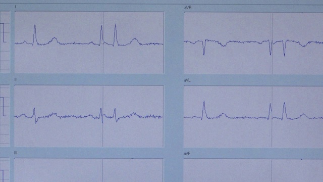 医用心脏监护仪测量心电图。视频素材