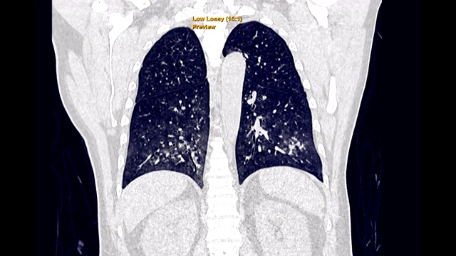 CT胸部或HRCT冠状面高分辨率肺过滤技术诊断结核病、结核病和covid-19。视频素材