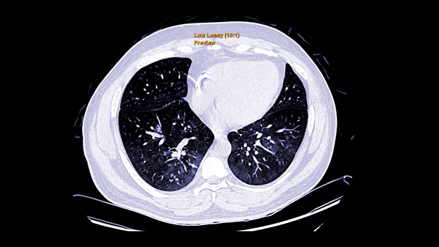 CT胸部或HRCT轴位高分辨率肺过滤技术诊断结核病、结核病和covid-19。视频素材