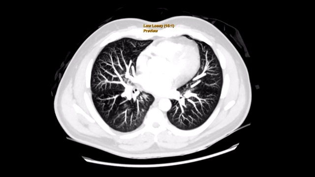 CT胸部或CT人胸部冠状位MIP视图肺过滤技术诊断结核病、结核病和covid-19。视频素材