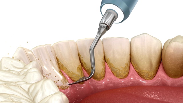 口腔卫生:超声波洁牙(常规牙周治疗)。医学上精确的人类牙齿治疗3D动画视频素材