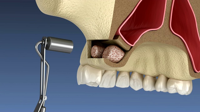 侧入路鼻窦提升术。牙科手术的3D动画视频素材