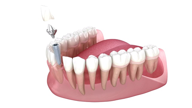 烤瓷冠，定制种植基台及种植体安装流程。牙科种植的医学精确3D动画视频素材