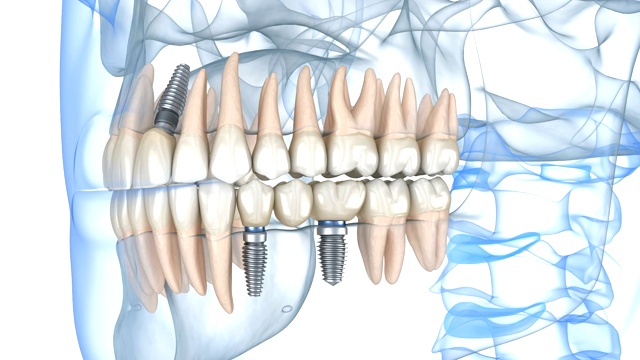 牙齿种植修复。医学上精确的人类牙齿和假牙的三维动画概念视频素材