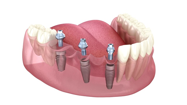 基于3个种植体的牙桥。医学上精确的人类牙齿和假牙的三维动画概念视频素材